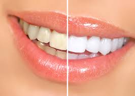 KöR teeth whitening