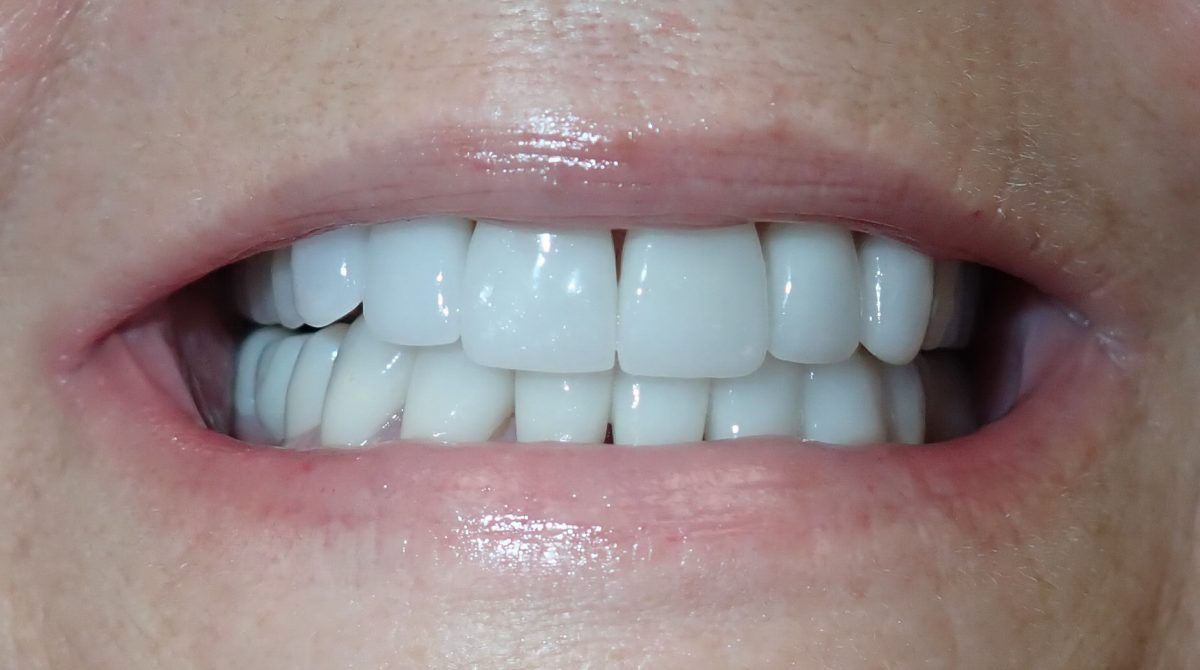 Michelle smile makeover dental crowns implants