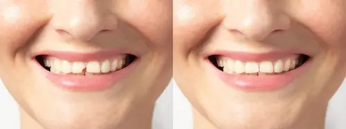 Broken Tooth Repair - Premier Smile Center