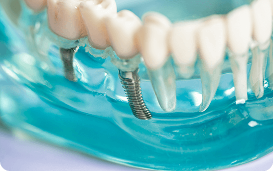 Dental implant fitting and crown placement