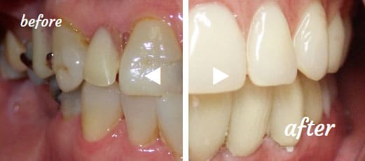 Before and after our dental services in Fort Lauderdale, FL