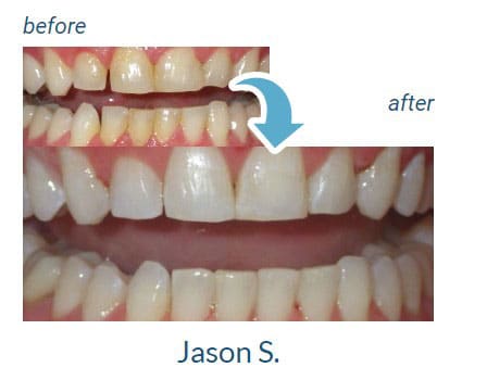 Jason's before and after our dental services