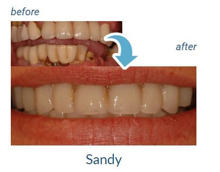 Sandy's before and after our dental services