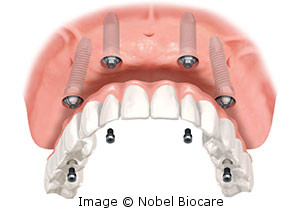 Diagram of an upper all-on-four implant denture.