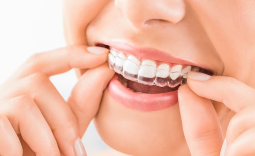 Invisalign in Fort Lauderdale