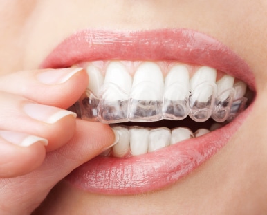 Invisalign fort lauderdale dentist