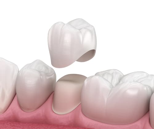 Porcelain Crown Diagram