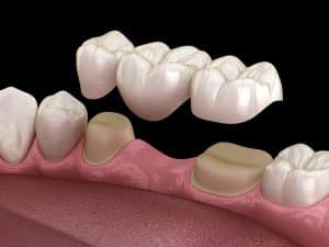 dental bridge