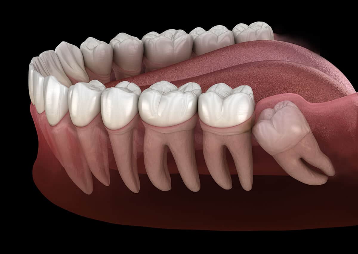 wisdom teeth extraction