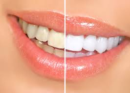 teeth whitening in fort lauderdale