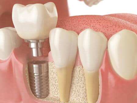 bone grafting