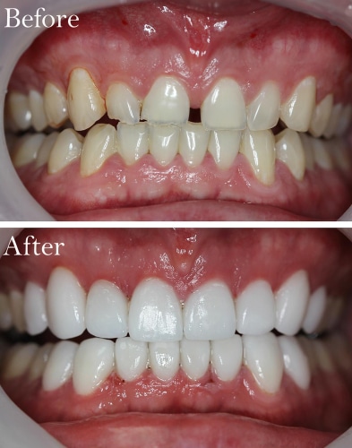 teeth makeover