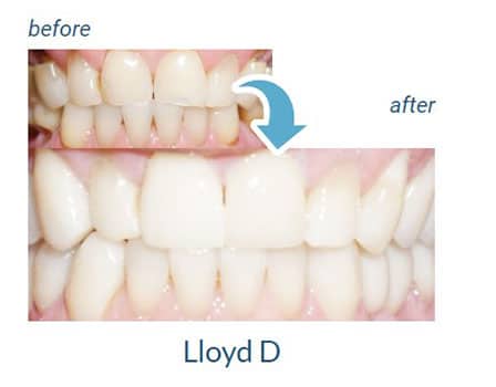 Lloyd's before and after our dental services