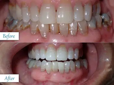Before and after cosmetic dental work showcasing improved tooth alignment and color