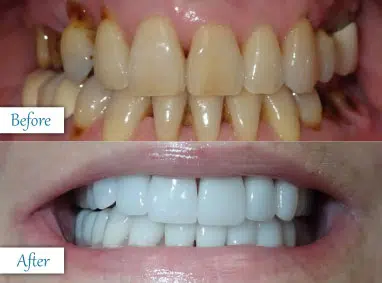 Before and after smile transformation showing improved teeth with cosmetic dentistry