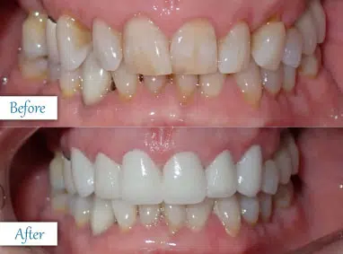 Cosmetic dental work before and after with bright, straight teeth and enhanced smile