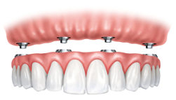 Illustration of the All-on-Four upper implant-supported dentures.