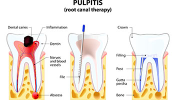 Diagram illustration of root canal treatment.