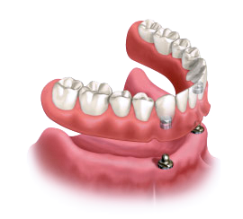 Illustration of implant-supported dentures.