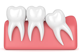 Illustration of an impacted wisdom tooth.