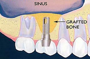 Sinus Lifts and Bone Grafting